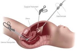 Affordable Hysterectomy Procedures Laparoscopic Traditional Options