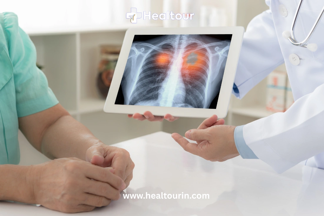 Lung Cancer Treatment Cost in India 