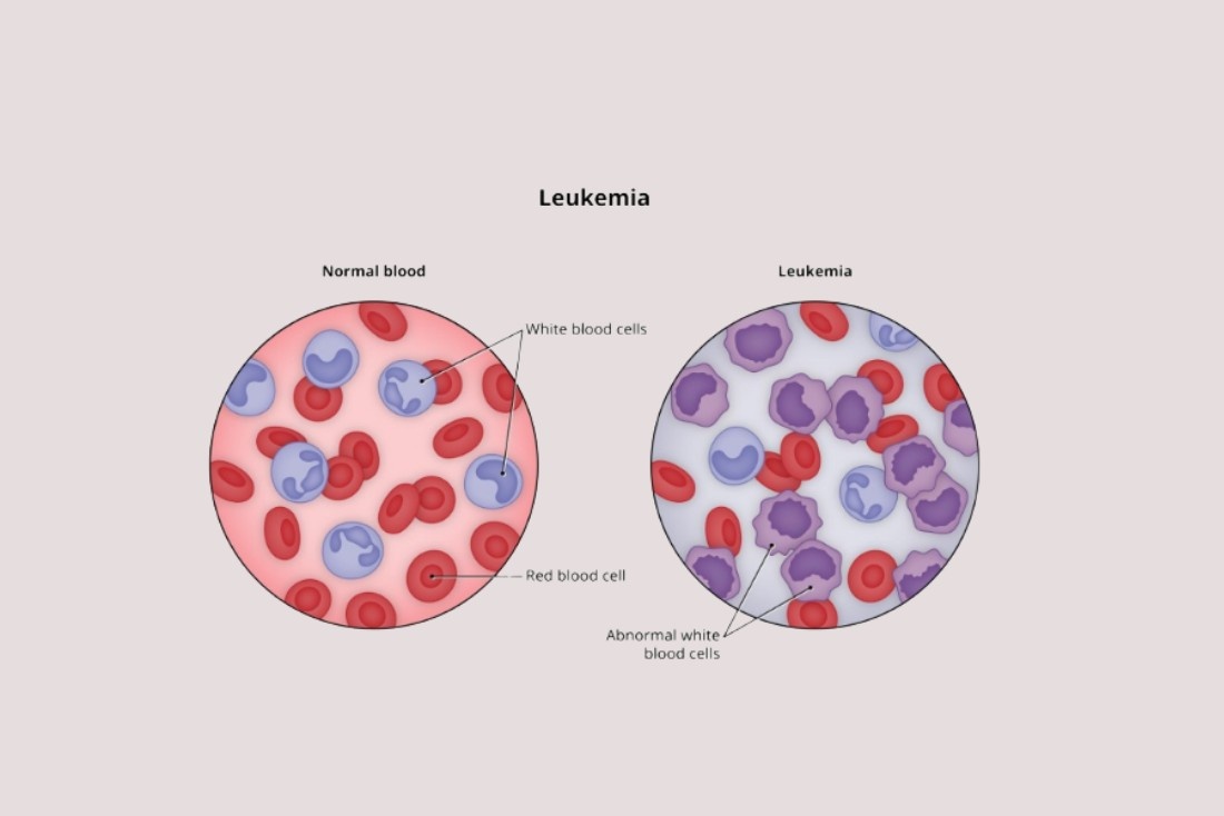 Leukemia Treatment Cost in India | Affordable Blood Cancer Care