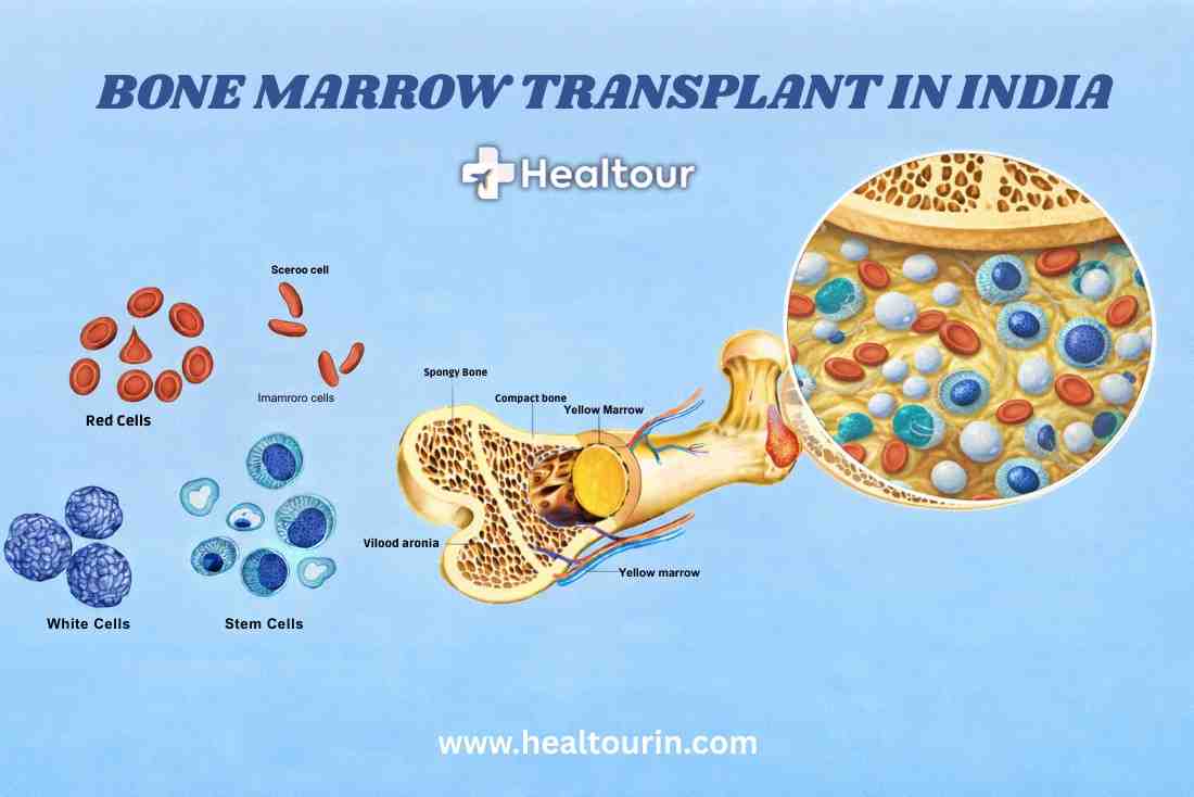 Bone Marrow Transplant in India | Procedure, Types & Cost 