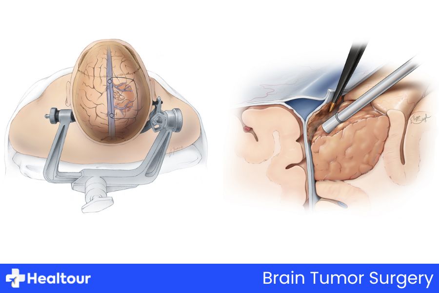 Brain Tumor Surgery