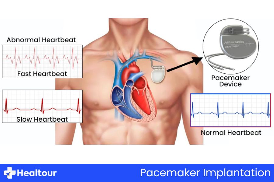 Pacemaker Implantation