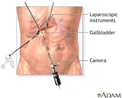 Gallbladder Surgery