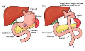 Gastrointestinal Cancer Surgery