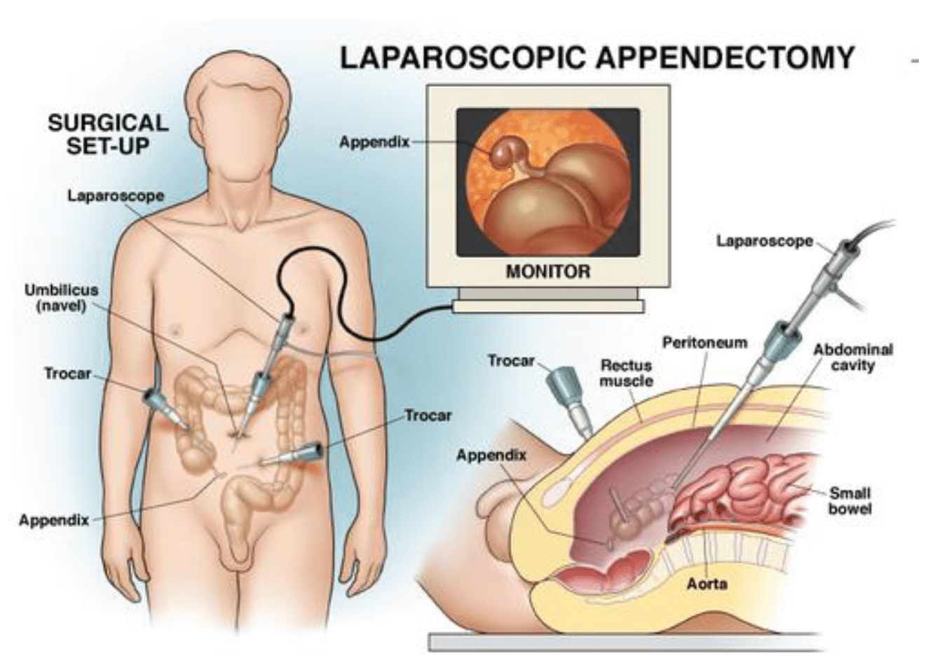 Appendectomy