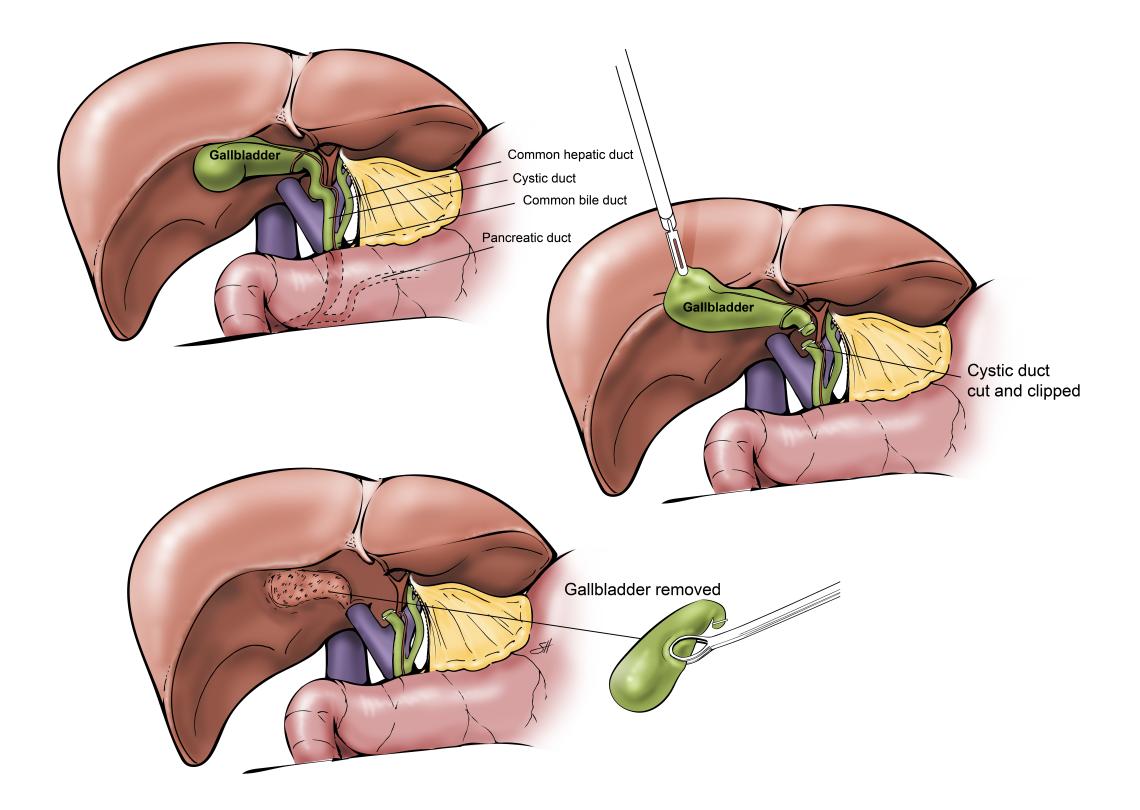 Gallbladder Surgery