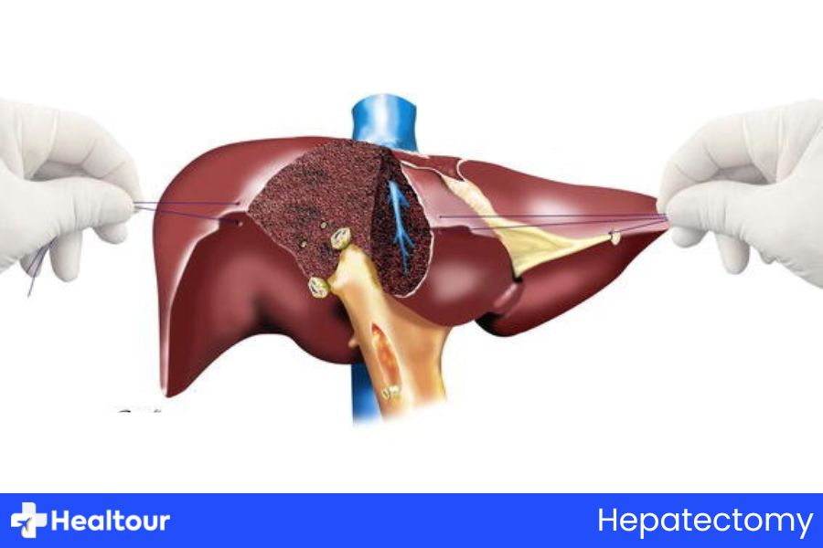 Hepatectomy