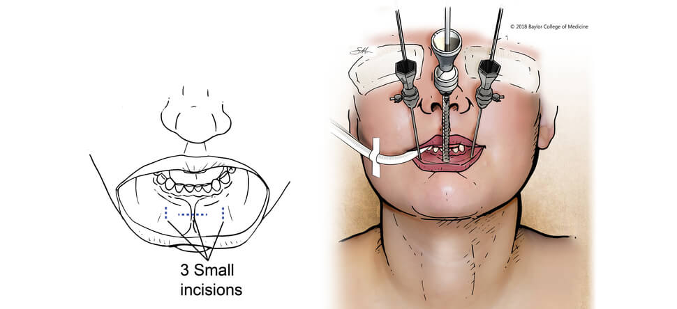 Thyroid Surgery