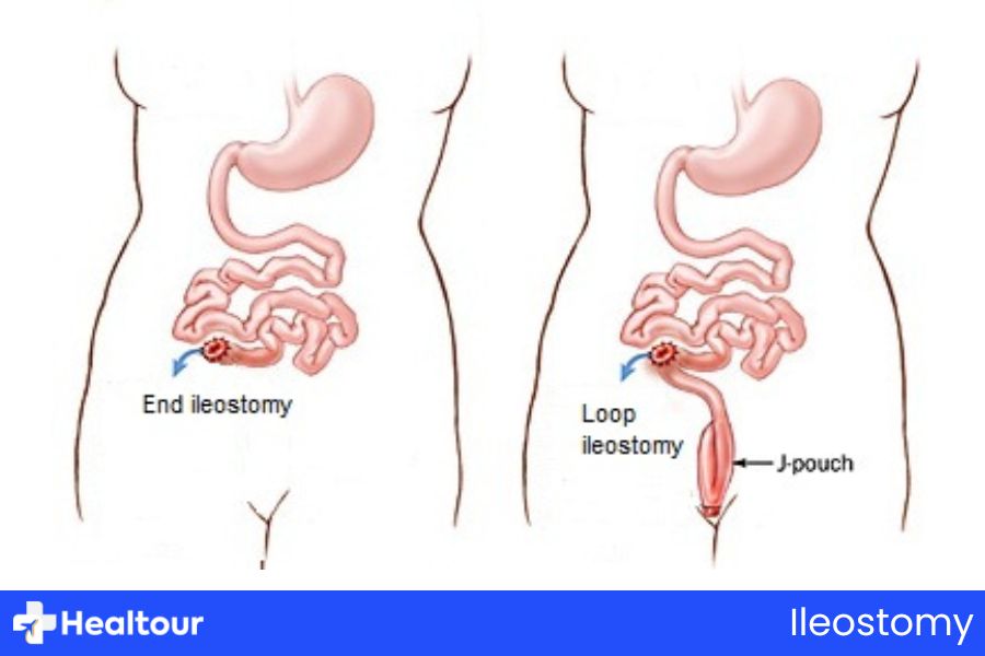 Ileostomy