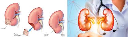 Kidney Cancer Surgery