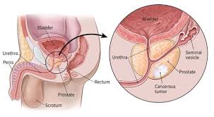 Prostate Cancer Surgery