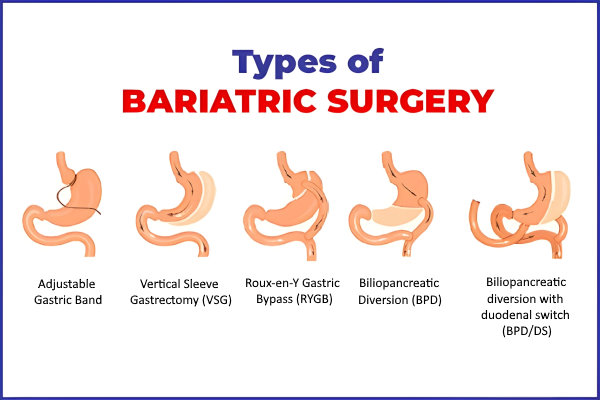 Bariatric Surgery 