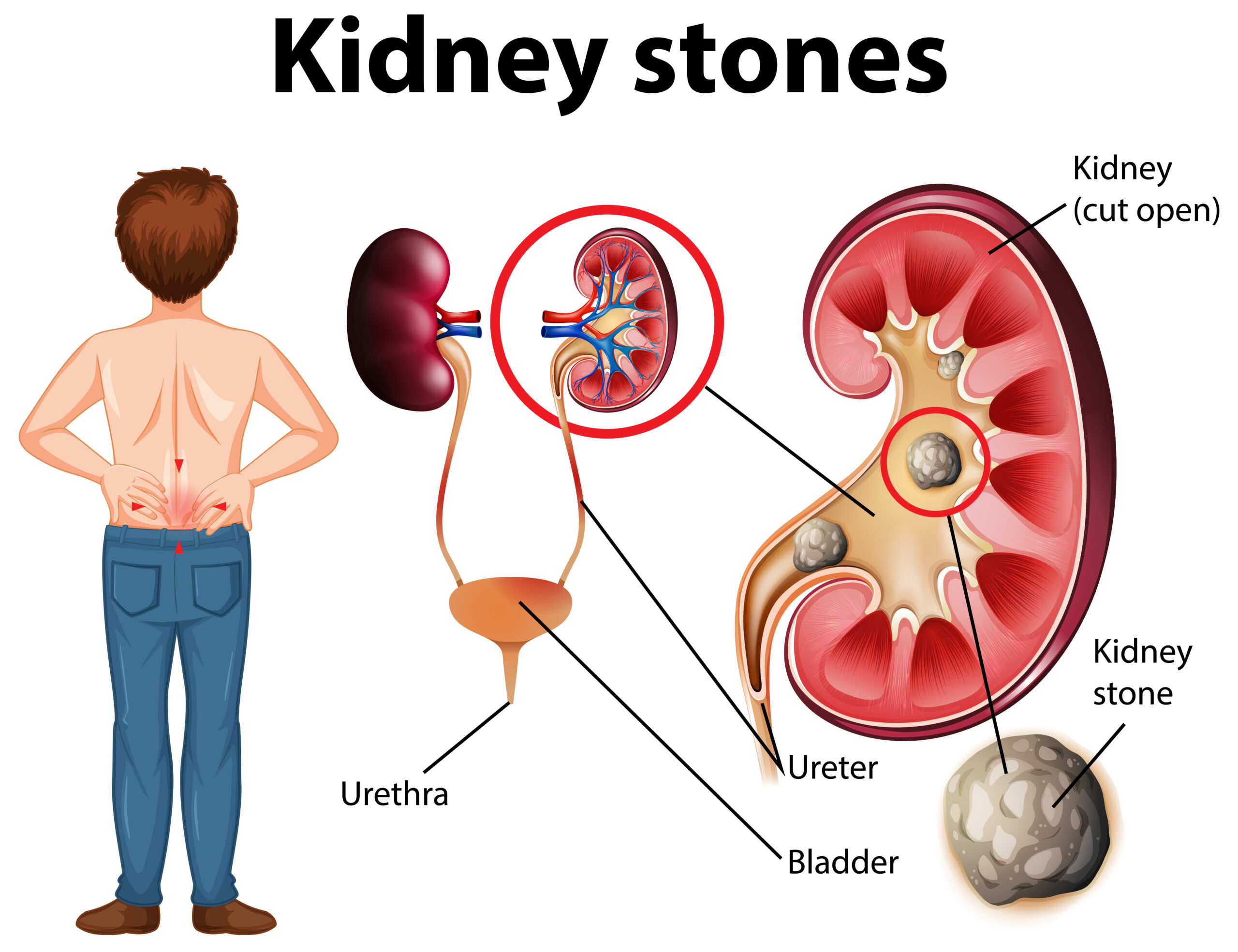 Kidney Stone Removal