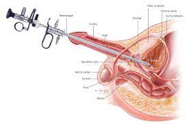 Bladder Cancer Surgery