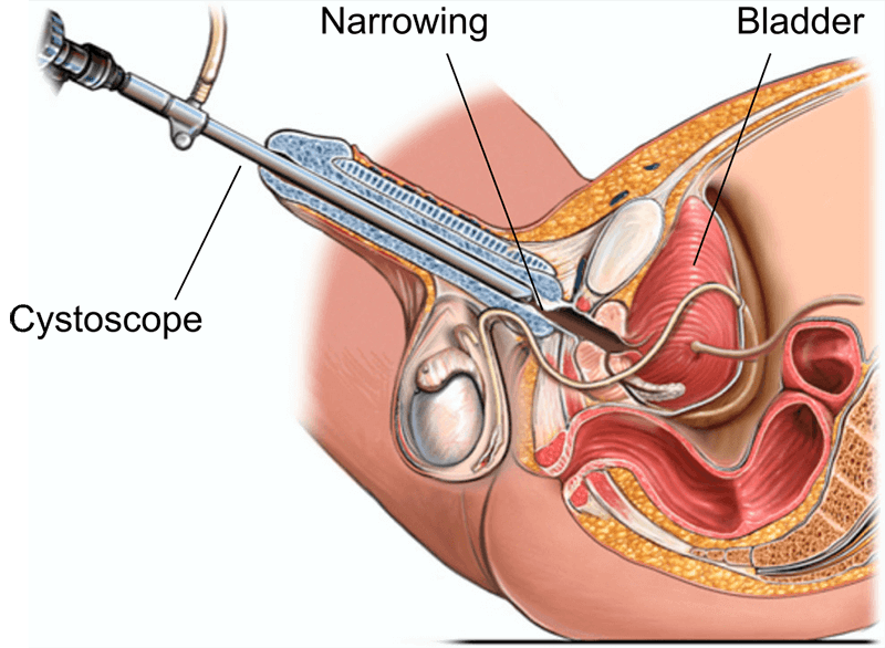 Urethral Surgery