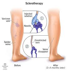 Varicose Vein Treatment