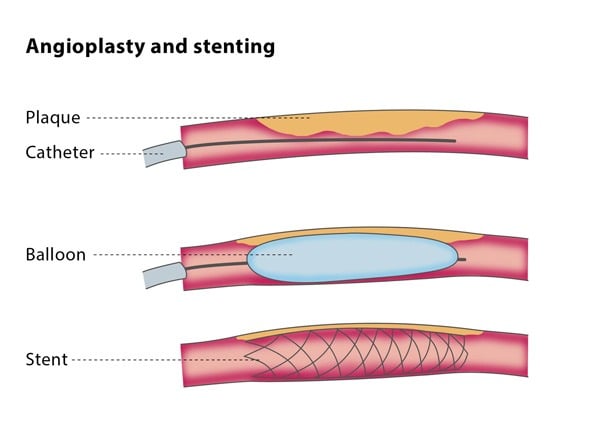 Endovascular Surgery