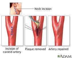 Carotid Artery Surgery