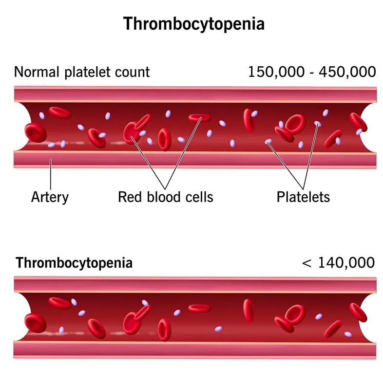 Platelet Disorders