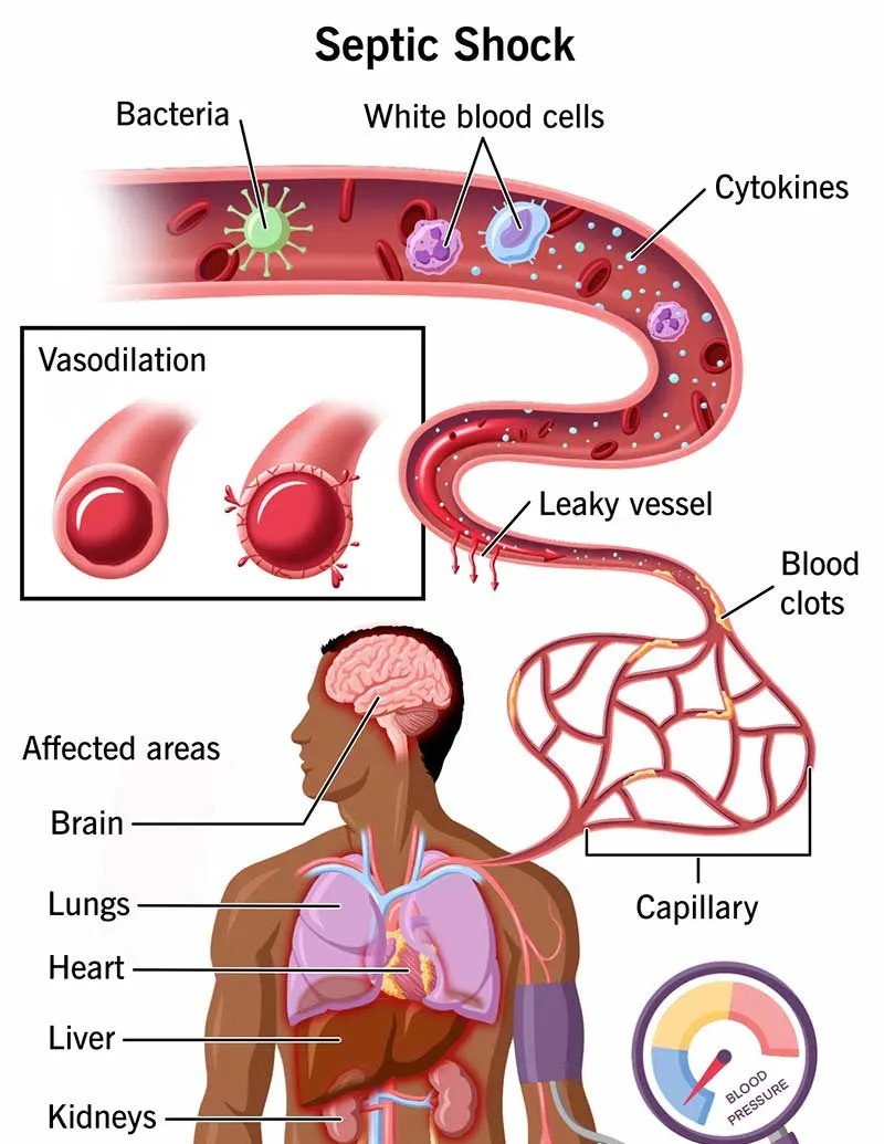 Septic Shock