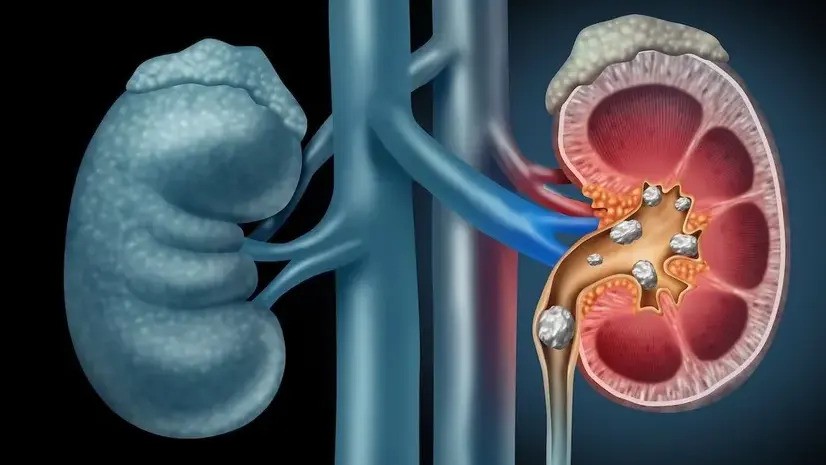 Ureteroscopy (URS) – For Kidney or Upper Ureter Stones