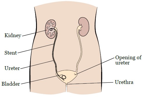 Ureteral Stent Placement/Removal