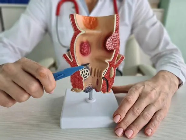 Fistula Treatment