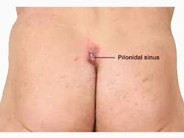 Pilonidal Sinus Treatment