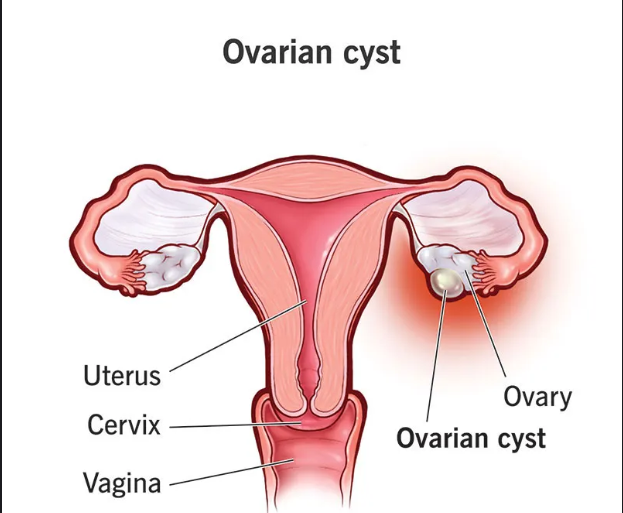 Ovarian cystectomy