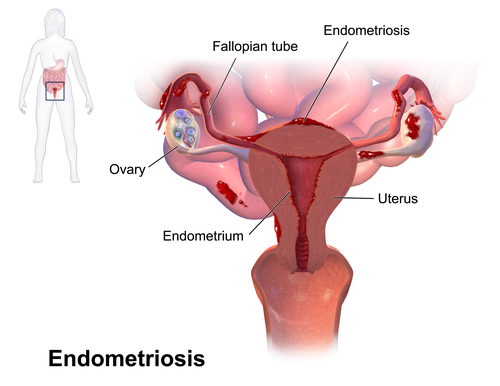 Endometriosis excision