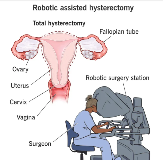 Robotic-Assisted Hysterectomy