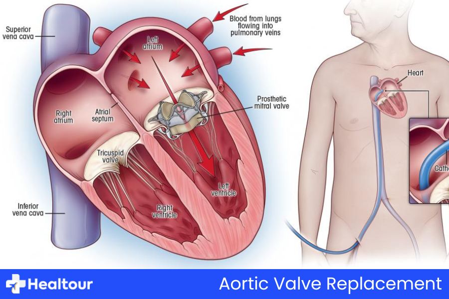 Aortic Valve Replacement